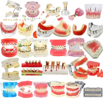 Dentare Dinți Model Dentare Modelul De Predare Standard Modele De Implanturi Ortodontice Model De Stomatologie Dentist Demo Studierea Imagine
